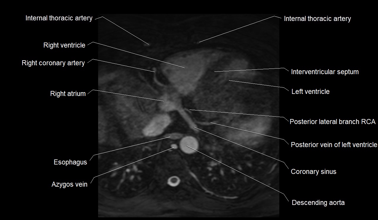 MRI heart coronary arteries and coronary veins anatomy axial image 37.jpg
